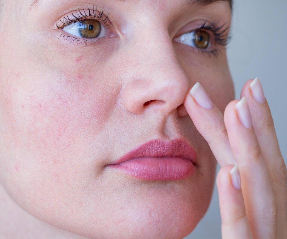 Rotes Gesicht Nach Cortisonspritze Wie Lange rosacea-info.de